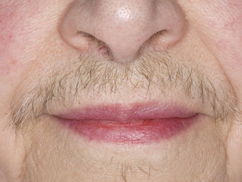 پر مویی ، علل ایجاد و نحوه درمان پر مویی چیست ؟