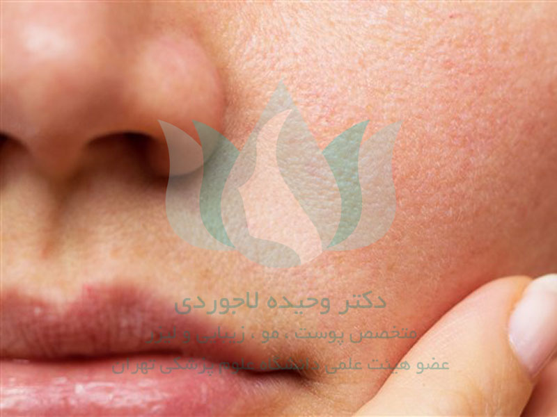 انواع پوست و رنگ پوست